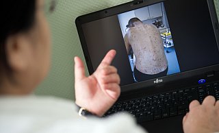 Wenn Krätzmilben nicht behandelt werden, breitet sich der Parasit weiter aus. - Daniel Naupold/dpa Wenn Krätzmilben nicht behandelt werden, breitet sich der Parasit weiter aus. - Daniel Naupold/dpa