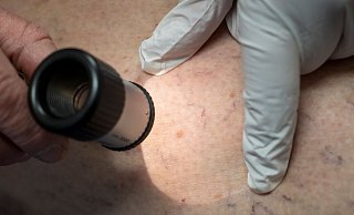 Die Zahl der Krankenhausbehandlungen von Hautkrebs stieg enorm an. (Symbolbild) - Peter Kneffel/dpa Die Zahl der Krankenhausbehandlungen von Hautkrebs stieg enorm an. (Symbolbild) - Peter Kneffel/dpa
