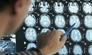Ein Arzt zeigt auf die CT-Aufnahmen eines Schlaganfallpatienten. Jeder fünfte Patient ist jünger als 55 Jahre. - Symbolfoto: Picture Aliance Ein Arzt zeigt auf die CT-Aufnahmen eines Schlaganfallpatienten. Jeder fünfte Patient ist jünger als 55 Jahre. - Symbolfoto: Picture Aliance
