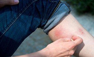 Mückenstiche lösen Juckreiz aus, richtig schmerzhaft ist der Stich einer Hornisse. Gefährlich wird es jedoch, wenn Bakterien eingeschleppt wurden. - picture alliance / dpa-tmn Mückenstiche lösen Juckreiz aus, richtig schmerzhaft ist der Stich einer Hornisse. Gefährlich wird es jedoch, wenn Bakterien eingeschleppt wurden. - picture alliance / dpa-tmn