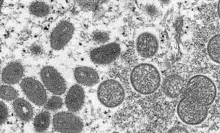 Im Kreis Höxter ist der erste Fall von Affenpocken nachgewiesen. - Cynthia S. Goldsmith/Russell Regner/CDC/AP/dpa Im Kreis Höxter ist der erste Fall von Affenpocken nachgewiesen. - Cynthia S. Goldsmith/Russell Regner/CDC/AP/dpa