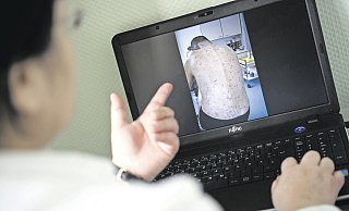 Das Foto zeigt einen an Krätze erkrankten Patienten. Die Milben bohren sich unter die Haut. - picture alliance / dpa Das Foto zeigt einen an Krätze erkrankten Patienten. Die Milben bohren sich unter die Haut. - picture alliance / dpa
