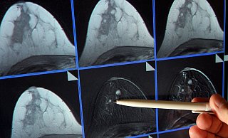 Bei einer Mammographie wird die Brust der Frau untersucht. - Picture Alliance Bei einer Mammographie wird die Brust der Frau untersucht. - Picture Alliance
